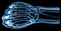 Fist under the x-rays Royalty Free Stock Photo