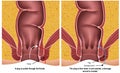 Fistula plug medical illustration on white background with description