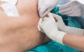 Fix epidural catheter