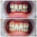 Before and after fixation for huge gap between front teeth or incisors, diastema Royalty Free Stock Photo