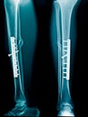 Fixation tibia bone