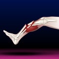 Leg Bone Fracture - Illustration - Healthcare - Science - Medical Treatment - Organ Royalty Free Stock Photo