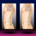 Spine Kyphosis - Spinal Cord - Human Anatomy - Healthcare - Science