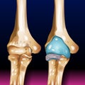 Elbow Dislocation, Elbow Bone Illustration, Pain, Forearm, Cramp, Illustration, Bone, Ache