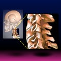 Neck Bone - Spinal Stenosis medical concept as a degenerative illness in the human vertebrae