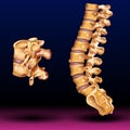 Spinal Stenosis medical concept as a degenerative illness in the human vertebrae