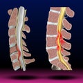 Spinal Stenosis - Symbol of spine curvatures or unhealthy backbones. Human spine anatomy Royalty Free Stock Photo