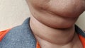 The flabbiness adipose and sagging skin under the neck, wrinkles and rough skin under the chin of the woman.. Royalty Free Stock Photo