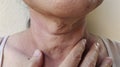 The Flabbiness adipose sagging skin, wattle and cellulite, wrinkles and flabby under the chin.