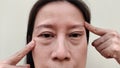 The Flabbiness skin, cellulite and bag under the eyes, wrinkles and ptosis beside the eyelid, forehead lines on the face