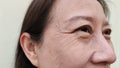 The Flabbiness skin, cellulite and bag under the eyes, wrinkles and ptosis beside the eyelid, forehead lines on the face