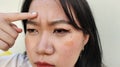 The Flabbiness skin, cellulite and bag under the eyes, wrinkles and ptosis beside the eyelid, forehead lines on the face