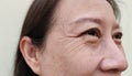 The Flabbiness skin, cellulite and bag under the eyes, wrinkles and ptosis beside the eyelid, forehead lines on the face