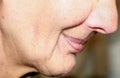 Flabbiness of the skin of the cheeks. Wrinkles on the face. Nasolabial wrinkles. Royalty Free Stock Photo