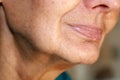 Flabbiness of the skin of the cheeks. Wrinkles on the face. Nasolabial wrinkles. Royalty Free Stock Photo