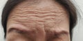 The flabbiness and wrinkle on forehead lines Royalty Free Stock Photo