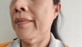 The flabbiness and wrinkles, dark spots and blemish on the face of the woman's