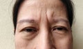 The flabbiness Wrinkles on forehead lines, Flabby skin under the eyes, ptosis beside the eyelid.