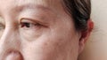 The Flabbiness and wrinkles, freckles and blemish on the face, dark spots and ptosis beside the eyelid