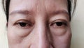 The Flabbiness and wrinkles skin, cellulite and bag under the eyes, wrinkles and ptosis beside the eyelid, forehead lines on the f