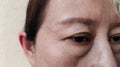 The Flabbiness and wrinkles skin, cellulite and bag under the eyes, wrinkles and ptosis beside the eyelid, forehead lines on the f