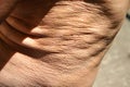 Flabby skin. Skin fold on the abdomen and chest