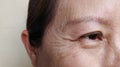 The Flabby skin, wrinkles and ptosis beside the eyelid