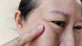 The Flabby skin, wrinkles and ptosis beside the eyelid