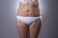 Flabby woman`s belly with stretch marks