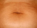 Flabby wrinkled abdomen. The navel is stretched.