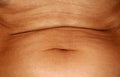 Flabby wrinkled abdomen. The navel is stretched.
