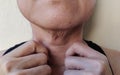 The Flabby wrinkled adipose sagging and wrinkles under the neck, cellulite under the chin.