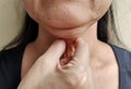 The Flabby wrinkled adipose sagging and wrinkles under the neck, cellulite under the chin.