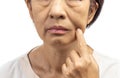 Flabby and wrinkled skin on senior woman face