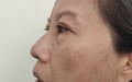 The Flabby wrinkles and freckles, dark spots and ptosis beside the eyelid