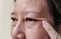 The Flabby wrinkles and ptosis beside the eyelid