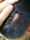 Scaly Scalp And Dandruff