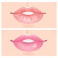 Flaky lips and beautiful lips