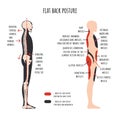 Flat back posture. The side view shows characteristic decrease natural curves of spine, pelvis rotation, stretched and weakened,