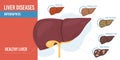 Flat cartoon infographic liver diseases vector illustration concept