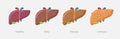 Flat design illustration of stages of liver damage