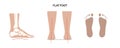 Flat feet anatomy