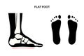 Flat feet anatomy