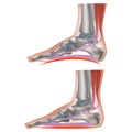 flat feet. Deformation of the longitudinal and parallel arches of the feet.