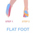 Flat foot. Correct kinesiology taping.