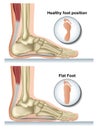 Flat foot medical vector illustration on white background Royalty Free Stock Photo