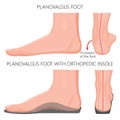 Flat foot with orthopedic insole_Exretnal wiew