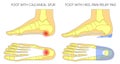 Flat foot with orthopedic insole_Heel pain relief pad