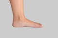 Flat foot of woman showing missing arch which can cause misalignment and orthopedic problems on white background