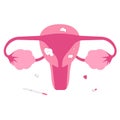 Flat illustration of uterine fibroid Royalty Free Stock Photo